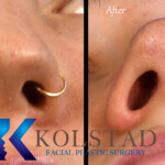 rhinoplasty scar example 151