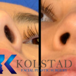 rhinoplasty scar example 152