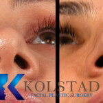rhinoplasty scar example 153