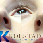 rhinoplasty scar example 158