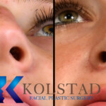 rhinoplasty scar example 159