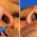 rhinoplasty scar example 160