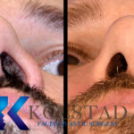 rhinoplasty scar example 161