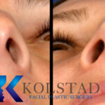 rhinoplasty scar example 162