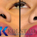 rhinoplasty scar example 163