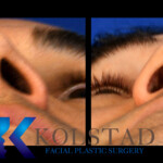 rhinoplasty scar example 164