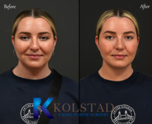 Ultrasonic Rhinoplasty California | Advanced Nose Surgery with Precision