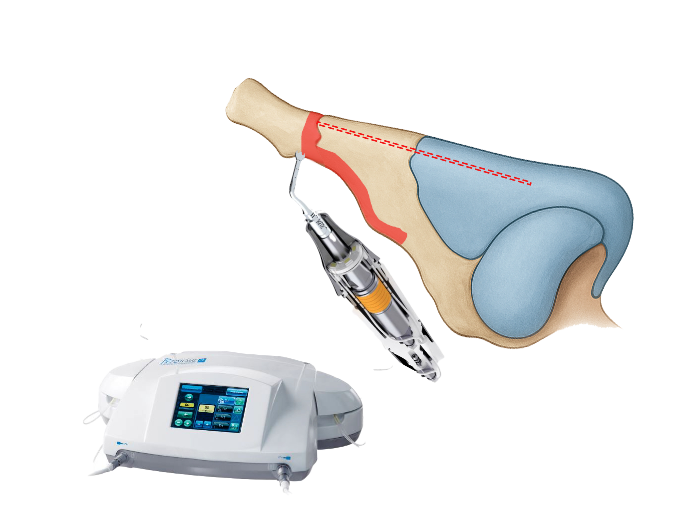 ultrasonic preservation rhinoplasty