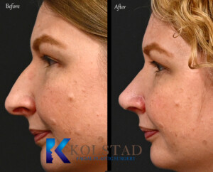 best dorsal preservation rhinoplasty