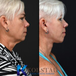 best face lift san diego