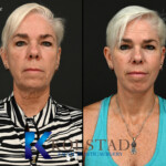 best facelift before and after