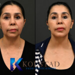 best facelift for dark skin women