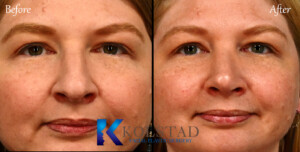 best preservation rhinoplasty