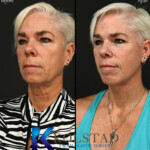deep plane face lift san diego