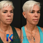 deep plane facelift