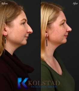 dorsal preservation before and after