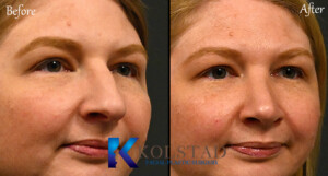 dorsal preservation results