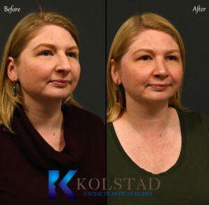 dorsal preservation rhinoplasty