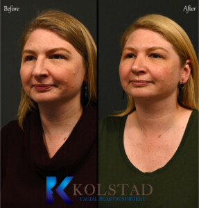 dorsal preservation rhinoplasty san diego