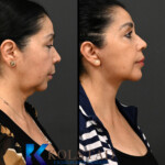 facelift for ethnic women