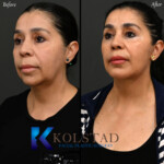 neck lift before and after