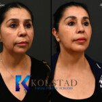 neck lift san diego