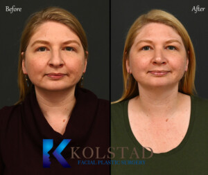 preservation rhinoplasty california