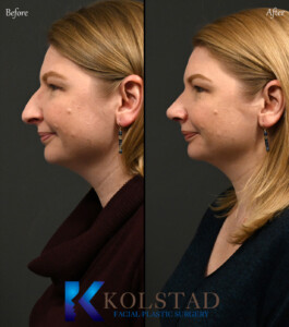 preservation rhinoplasty san diego