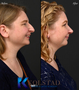 san diego dorsal preservation before and after
