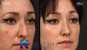 Before and after image of best nose job with natural, refined results