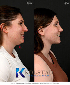 Before and after photo showing best preservation rhinoplasty results with natural nasal contour