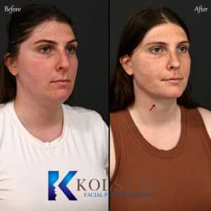 Best Preservation Rhinoplasty California