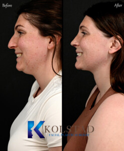 Patient results from the best preservation rhinoplasty in San Diego showing natural nose contour and minimal swelling