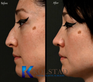 Results from the one of the best preservation rhinoplasty surgeon in California