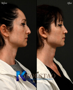 Before and after of best ultrasonic rhinoplasty in California with refined nasal contour.