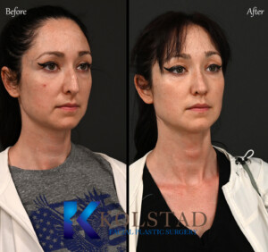 Preservation Rhinoplasty