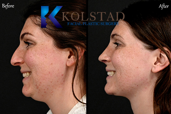 preservation rhinoplasty California