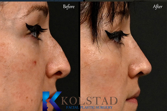  PIEZO RHINOPLASTY CALIFORNIA