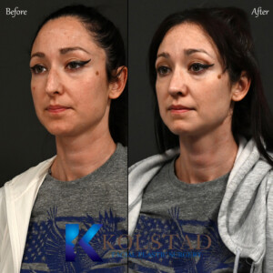 Results by a nose job expert in California showing refined nasal shape and improved profile.