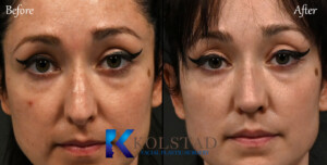 Before and after photo of a nose job for droopy tip correction.