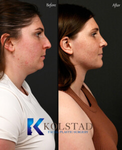 Before and after results of preservation rhinoplasty showing natural nose reshaping