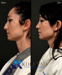 Before and after results of preservation rhinoplasty performed in California.