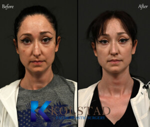 rhinoplasty for droopy tip