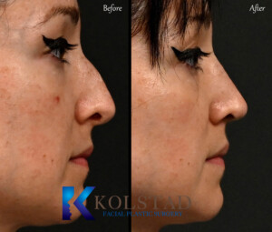 san diego ultrasonic rhinoplasty specialist