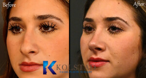 Best piezo rhinoplasty surgeon in California using advanced ultrasonic technology for precise nose reshaping.