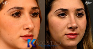 Best piezo rhinoplasty surgeon in San Diego performing ultrasonic nose reshaping with precision tools.
