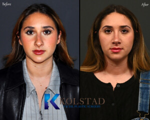 Top facial plastic surgeon in California performing ultrasonic rhinoplasty using piezoelectric instruments.