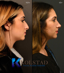 Facial plastic surgeon performing piezo rhinoplasty with ultrasonic instruments.