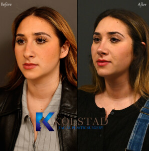 Piezo rhinoplasty in San Diego