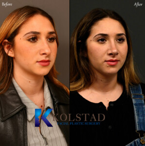 Piezo rhinoplasty procedure in San Diego